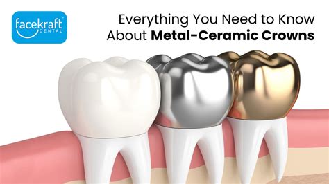 fabrication of metal ceramic crown|prefabricated porcelain ceramic crowns.